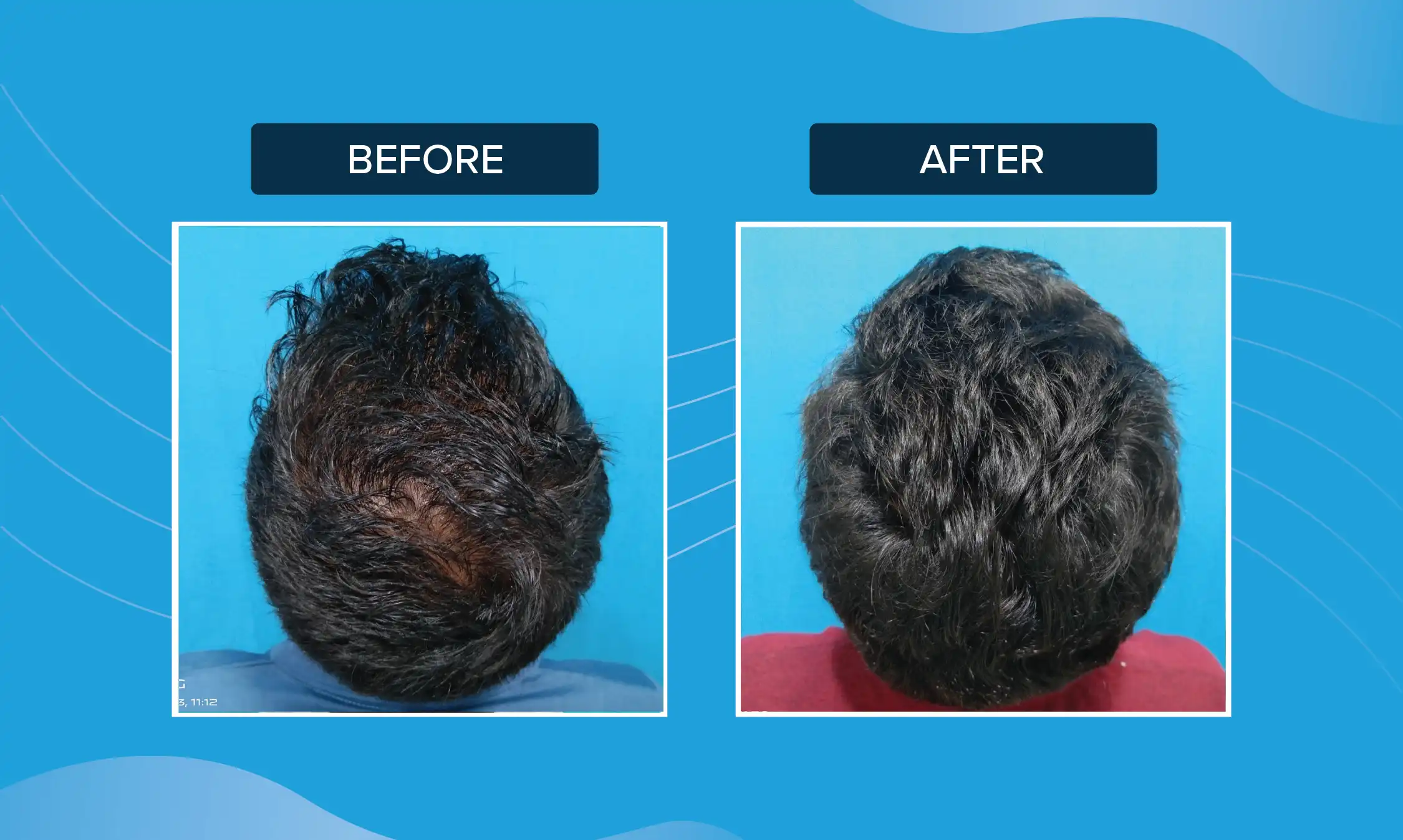 prp hair treatment cost